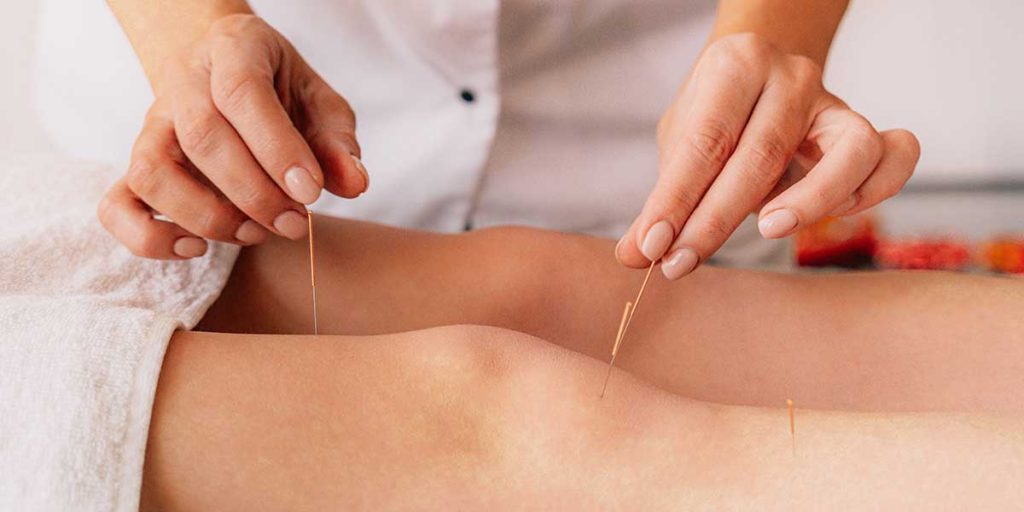 Acupuncture on woman's legs. 