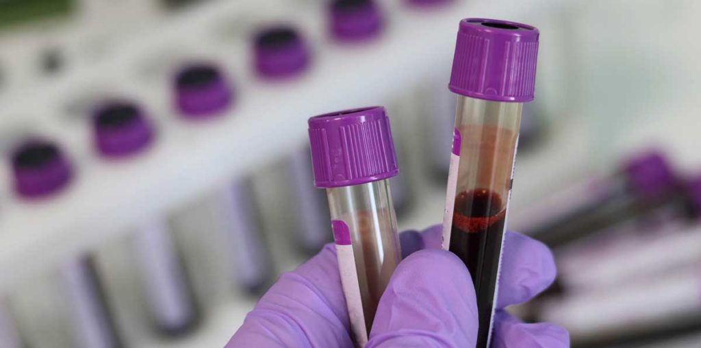 Person with purple gloves in lab holding two tubes of blood work.