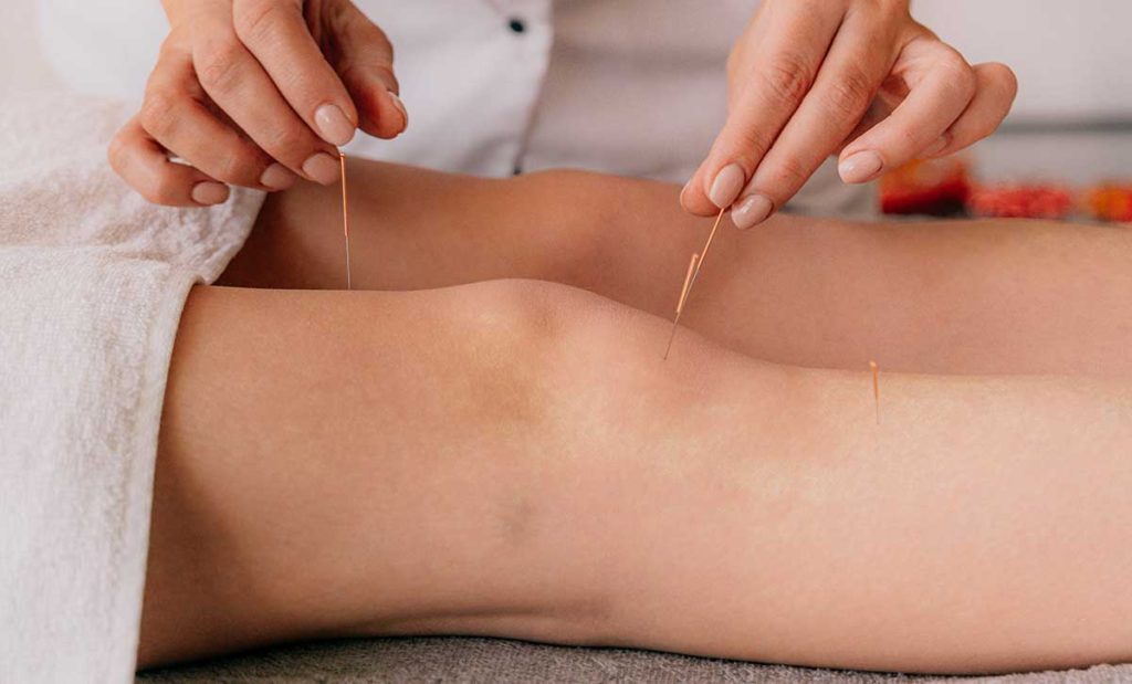 Woman getting acupuncture in knee.